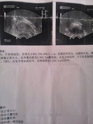 早孕测出阳,右附件区囊性块,宫颈囊性块盆腔积液求助