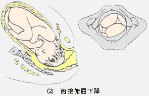 想知道宝宝怎么经过产道的进来看看    初产妇胎头下降速度较经产妇慢