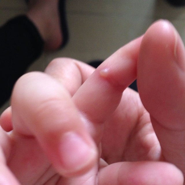 宝宝手指头长了个小水泡