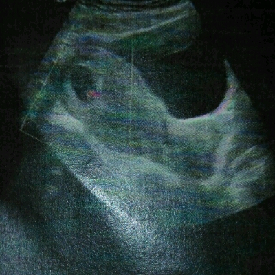 怀孕6 周 从胎囊看是男孩还是女孩 求解