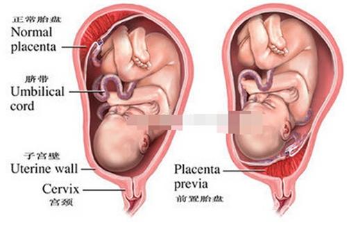 胎盘前置指的是胎盘覆盖在子宫颈内口或者位於其下段,位置低於胎儿的