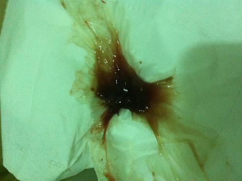 宝妈们帮我看看这是宫颈粘液吗(有图慎入)