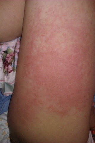 体内湿热才会湿疹                                         展开