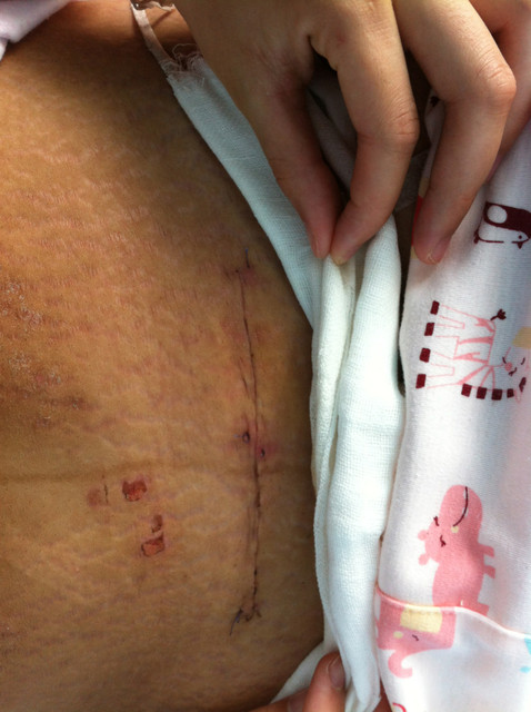 剖腹产的宝妈你们的伤口拿来比较比较