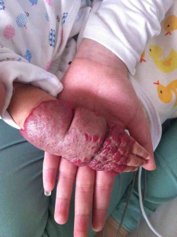 宝宝得了血管瘤,知道的宝妈帮帮忙!还有关于保险问题!