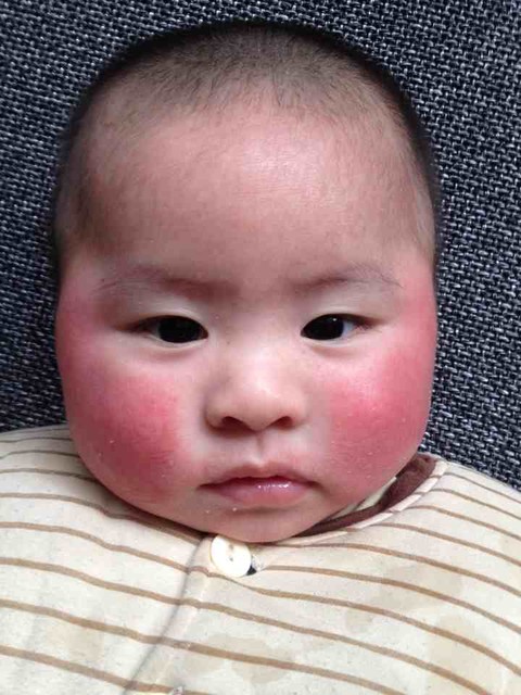 一到晚上就高原红_最近几天一到晚上宝宝脸上就飘起两砣高原红_宝宝树