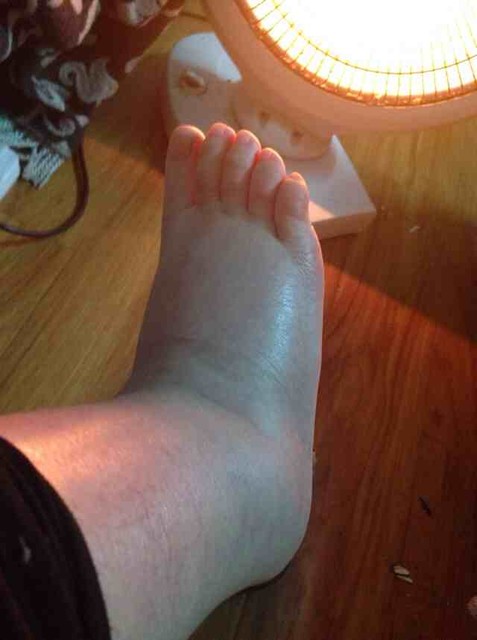 谁有我的猪蹄肿?