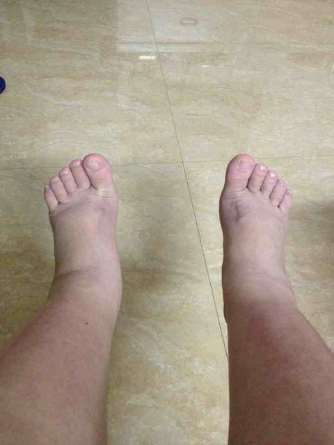 有脚肿痛的宝妈吗?