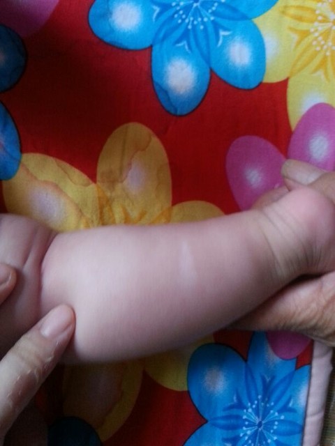 宝宝腿上有一块白斑图图片