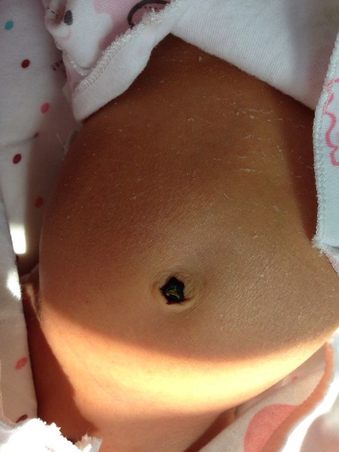 宝宝肚脐眼这样是感染了吗?