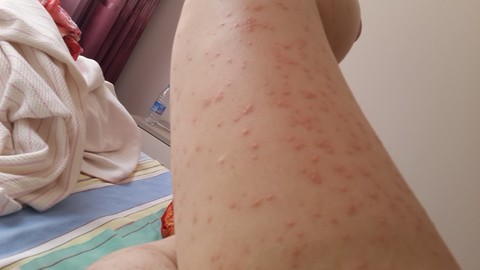 全身都痒咋回事?