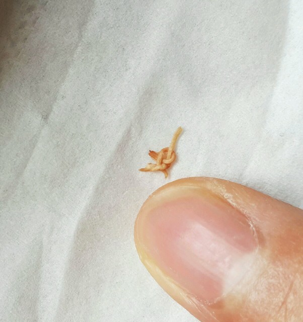 顺产14天撕裂缝合的线头掉了有没关系?