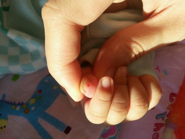 求助 宝宝手被指甲刀剪伤了 怎么办