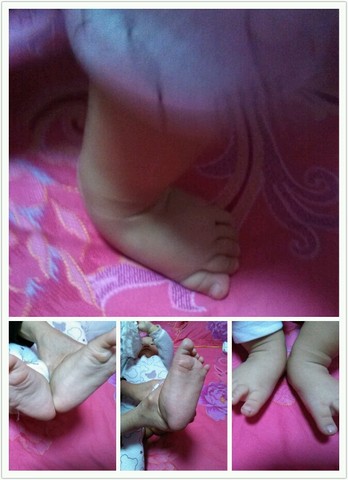 宝宝的足外翻脚!