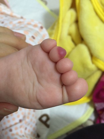 怀孕的妈妈们进来看看……如何预防胎儿血管瘤?