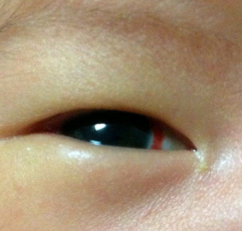 新生儿的黑眼球和白眼珠之间有半圈红