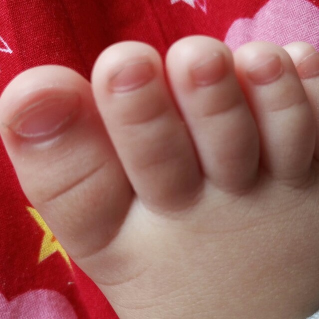 宝宝指甲扁平图片图片