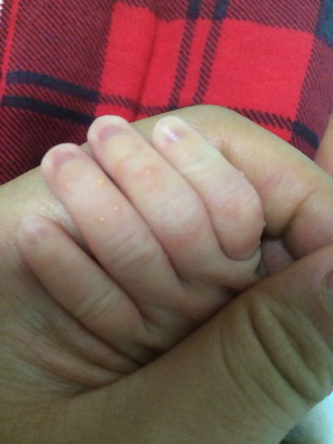 宝宝手脚长了很多黄色小水泡,有了解的宝妈吗