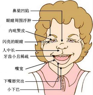 宝宝被确诊威廉姆斯综合症