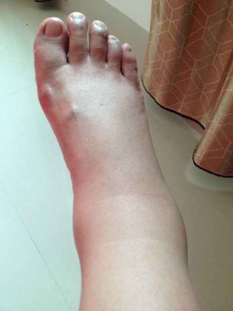 怀孕6个多月,脚水肿成这样