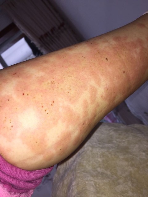 孕后免疫力下降 贫血 体内湿气重有湿疹的宝妈进来看