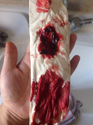 纸巾沾血的真实图片图片