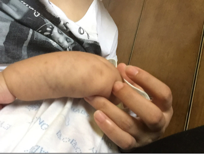 生出的时候左手手臂上就有明显的毛细血管,现在快三个月了,比出生的