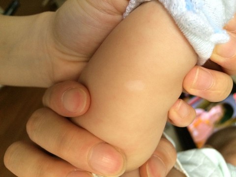 无色素痣宝宝身上长的,有没有宝妈知道怎么治好的啊