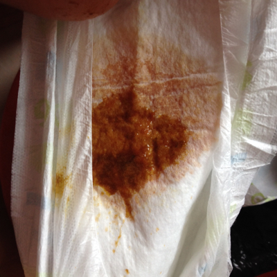 医生我家宝宝从出生到现在一直拉肚子,之前颜色是黄色的,现在是咖啡色