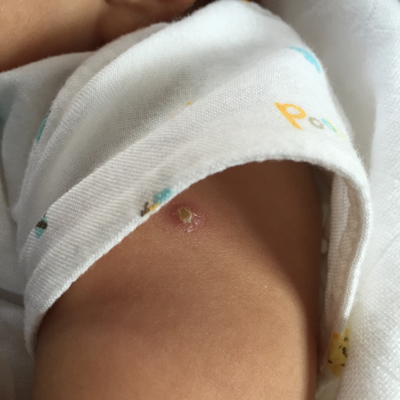 婴儿预防针结痂正常图图片
