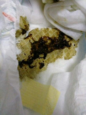 还不停的哭着要吃奶,餵了差不多二十毫升的奶