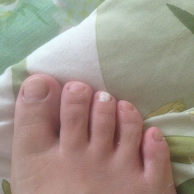 哺乳期突然发现一个脚趾甲变白了,初步判断是灰指甲,各位亲们有没有