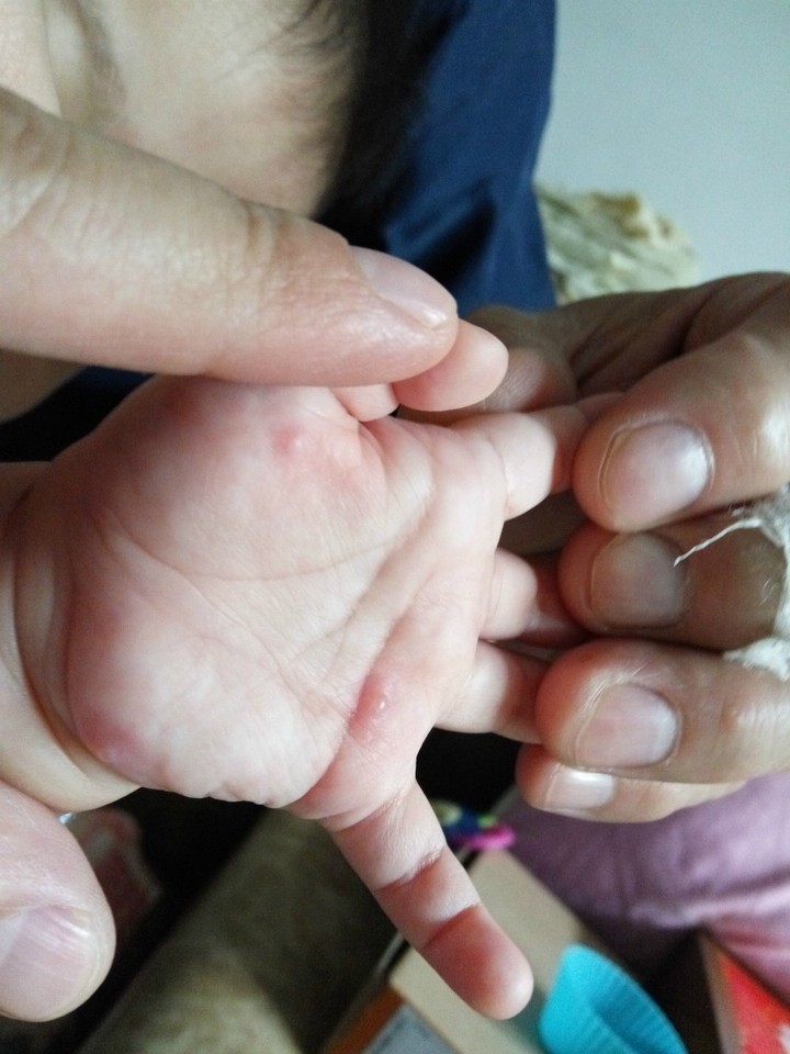 宝宝水痘图片早期婴儿图片