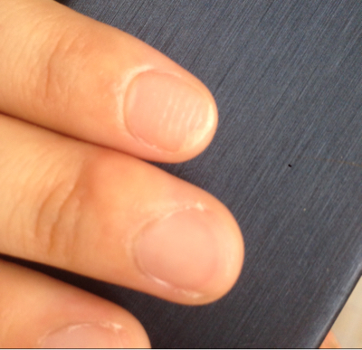 右手食指手指甲最近不平,坑坑洼洼的