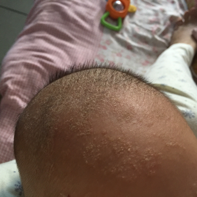 宝宝两个多月额头和头上一直有张像头皮屑白色的结痂请问该怎麼处理