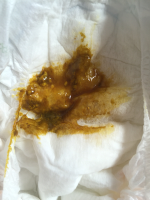 宝宝拉臭臭粘粘的黄色但颜色有点黑裏面有白色颗粒怎麼办