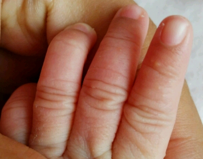 宝宝出生18天,今天发现她手指和脚趾长了很多小小的水泡,请问是怎麼回