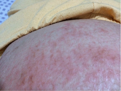 亲们,我是不是橄榄油过敏喔,每次肚子一点点痒就擦油,结果都是更严重!