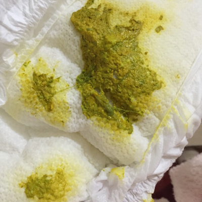 或金黄色软膏状,比较稀,有酸味没有泡沫,有时有奶块或绿色也属正常