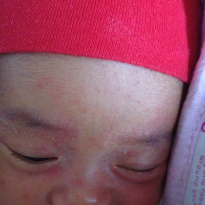 我女儿还有两天满月 脸上的东西起好几天了 这是不是胎毒