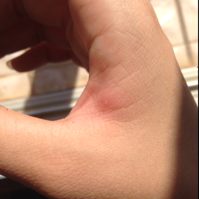 我昨天被蚂蚁咬了,今天就有点小红肿,中间有个白脓点,怎麼办?