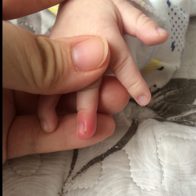 我家宝宝的手指头叫我给他剪手指甲是剪破了现在手指头红成这样怎麼办