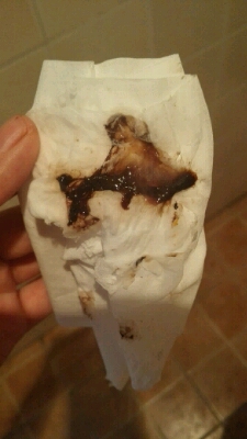 怀孕七周,上厕所在马桶发现的,很恶心,像是白带混着黑色的分泌物,这是