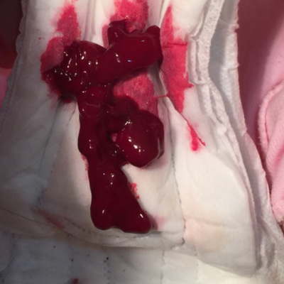 产后第15天时下面大出血(一次性涌了很多鲜红色血出来并伴有果冻状