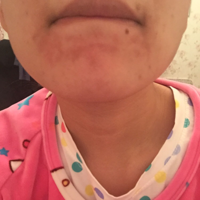 怀孕3个月了,嘴唇底下发红发黑,是怎么回事?有什么好的办法吗?