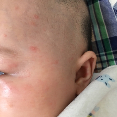 新生儿脸上有红斑图片