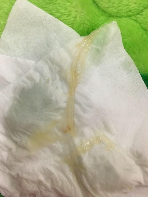 出现宫颈粘液栓是快生了吗