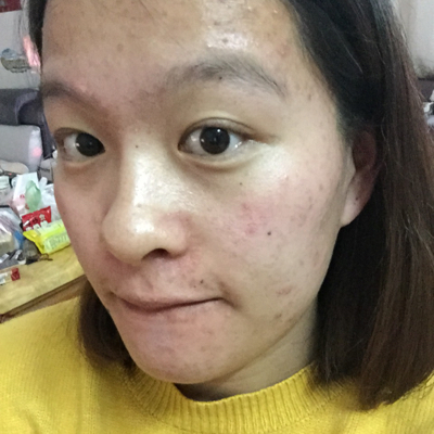 我是油性敏感肌肤,孕前就一直长痘,现在怀孕六个月了,脸和发际线交界