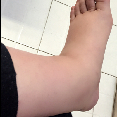 有宝妈九个月的时候脚肿的跟我一样嘛,不能走路了,脚面好疼,这是快生