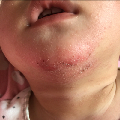 宝宝这下巴痒的不得了 多抓破皮 请问这是不是湿疹引起?